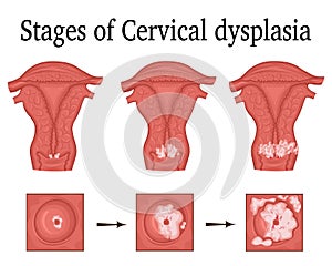 Illustration of Cervical dysplasia