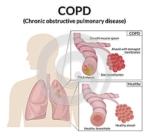 Illustration of Chronic Obstructive Pulmonary Disease