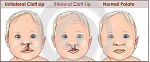 illustration of a cleft palate in a child. plastic surgery. reconstruction of the upper palate