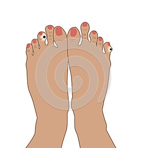 Illustration close-up of wart verrucas plantar or cone on little and middle finger on white background