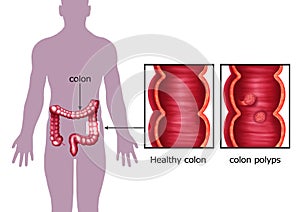 Illustration of the colon cancer