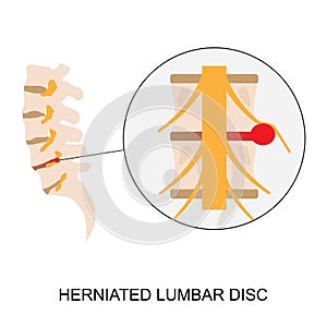 Illustration demonstration of human herniated lumbar disc