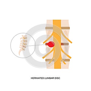 Illustration demonstration of human herniated lumbar disc