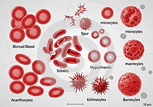 Abnormal red blood cell morphologies, including Acanthocytes,
