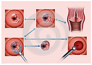 Illustration describing the process of cauterization of the cervix affected by cancer photo