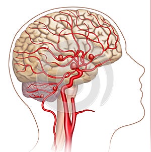 Illustration and descriptive scheme of the aneurysm in the human brain. photo