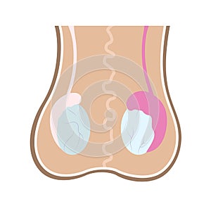 Illustration of epididimis inflamation on one of testicles compared to healthy one. Infographics in human anatomy for