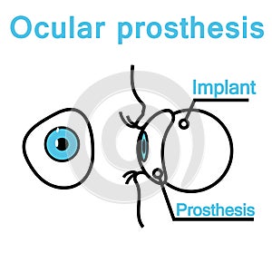 Illustration of an eye prosthesis