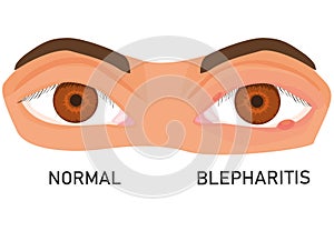 Illustration of eyes with barley. eye diseases. eyelid inflammation. blepharitis. flat vector. photo