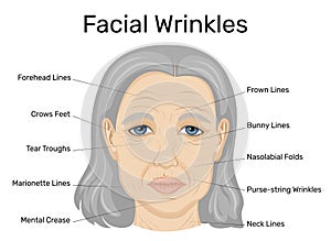 Illustration of facial wrinkles photo
