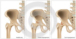 Illustration of the Femoroacetabular Impingement. Different of the Cam impingement and Pincer impingement. Healthy hip