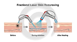 Illustration of fractional laser skin resurfacing procedure photo