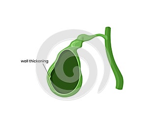 Illustration of the gallbladder wall thickening. Vector immage of the gallbladder anatomy with thick wall. Local cholecystitis