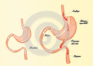 Illustration of Gastric bypass