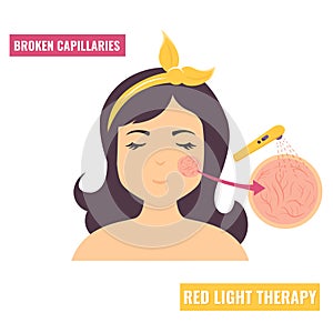 Illustration of a girl with broken cappilaries.