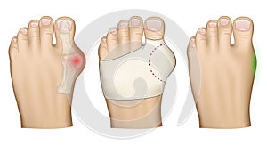 Illustration of the Hallux valgus problem.