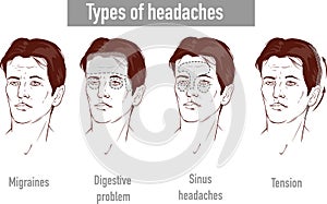 Illustration about headaches 4 type on different area of patient