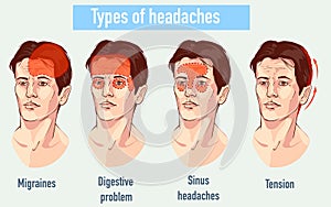 Ilustrace o bolesti hlavy 4 typ na odlišný oblast z 