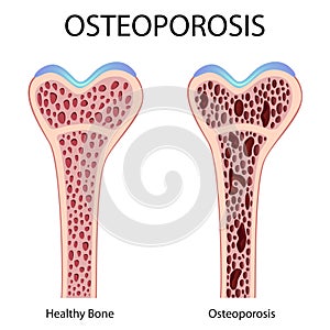 Osteoporóza 
