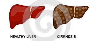 Illustration of healthy and diseased liver. Cirrhosis. Isolated art on white background. Vector. Cartoon. Flat.