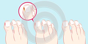 Healthy foot and ingrown nail photo