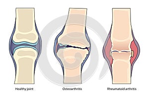 illustration of healthy joint vs arthritis comparison
