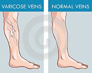 Illustration of a healthy leg and the affected varicose veins.