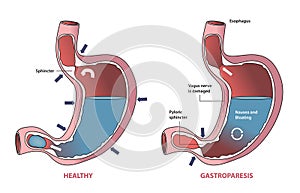 illustration of gastroparesis photo