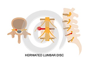 Illustration of herniated lumbar disc in different view
