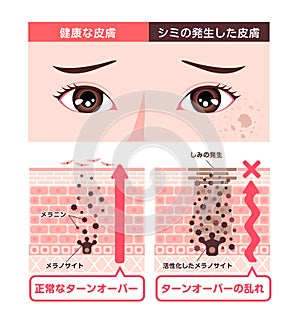 Illustration of how skin spots (hyperpigmentation) are created