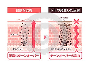 Illustration of how skin spots (hyperpigmentation) are created