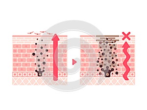 Illustration of how skin spots (hyperpigmentation) are created