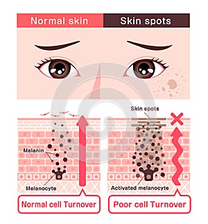 Illustration of how skin spots (hyperpigmentation) are created