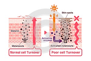 Illustration of how skin spots (hyperpigmentation) are created