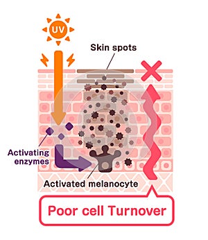 Illustration of how skin spots (hyperpigmentation) are created