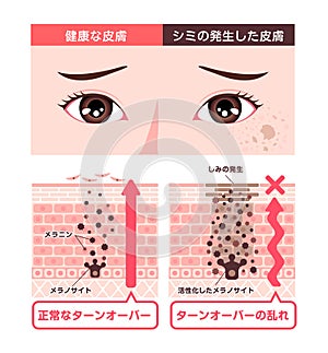Illustration of how skin spots (hyperpigmentation) are created photo