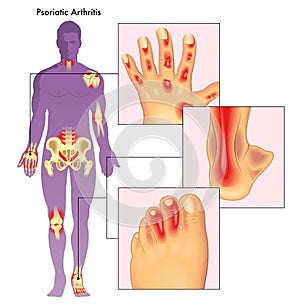 Psoriatic arthritis illustration photo