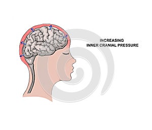 increasing inner cranial pressure. photo