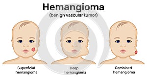 Illustration of infantile hemangioma photo