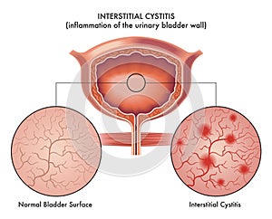 Illustration of interstitial cystitis