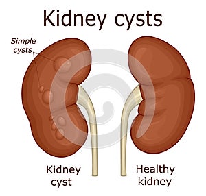 Illustration of kidney cysts