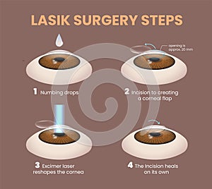 illustration of lasik eye surgery steps