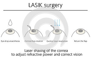 Illustration, LASIK vision correction, medical illustration photo