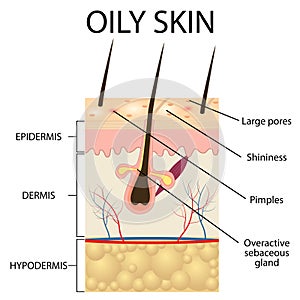 Illustration of The layers of oily skin photo