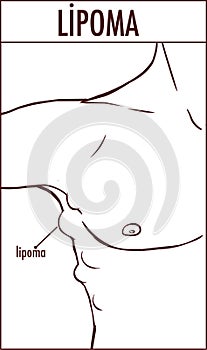 Illustration of a lipoma. photo