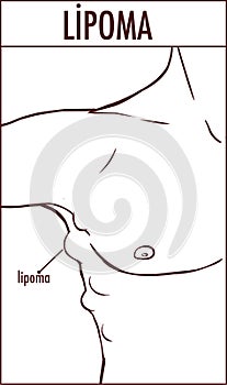Illustration of a lipoma.