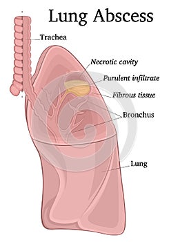 Illustration of lung abscess photo