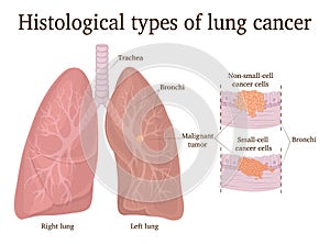 Illustration of lung cancer types