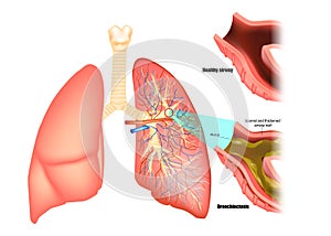 Illustration of lungs affected by bronchiectasis disease. Obstructive lung disease