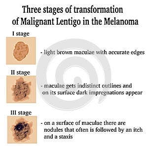 Illustration of Malignant Lentigo